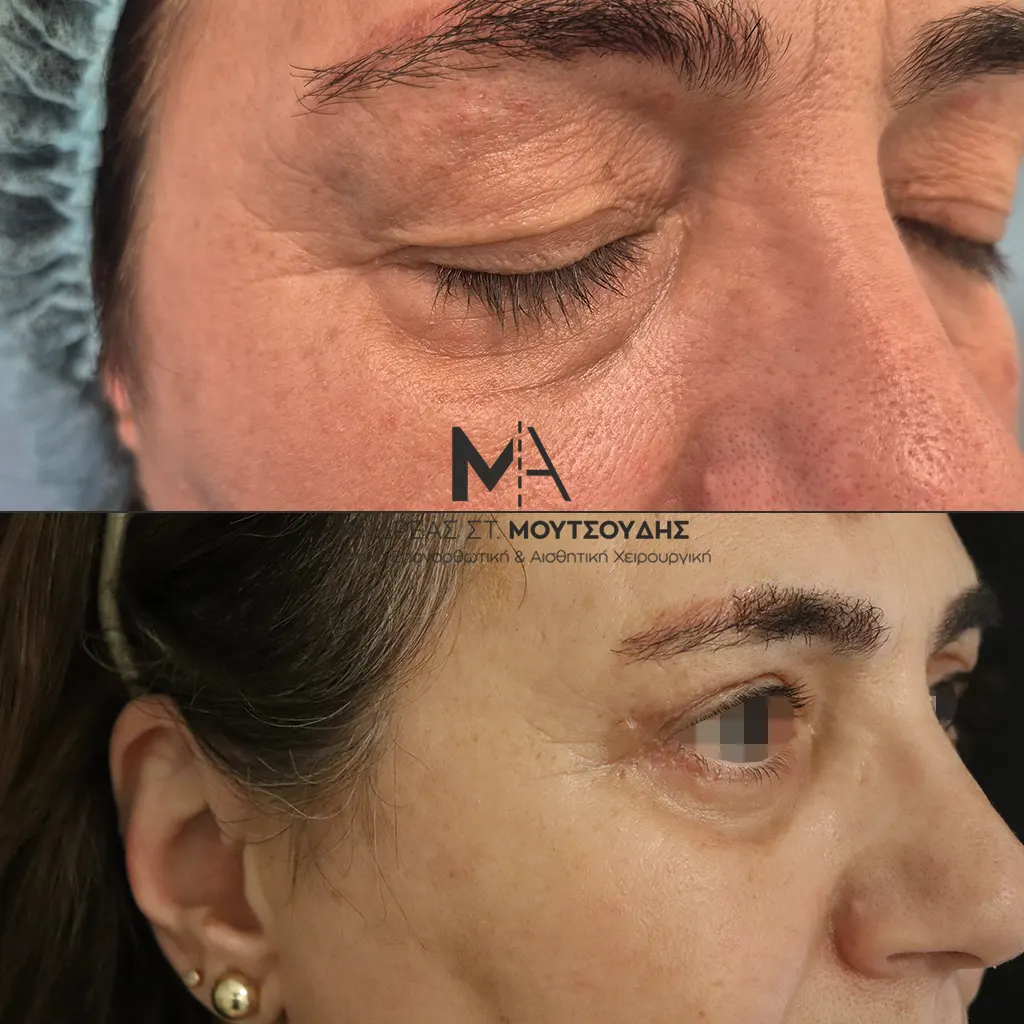 Βλεφαροπλαστική μέσα από αληθινές φωτογραφίες Πριν και Μετά