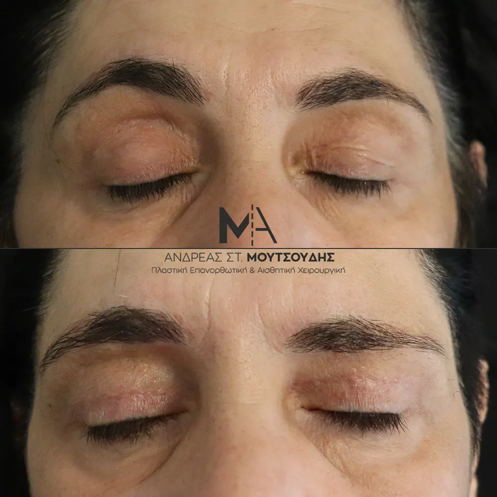 Βλεφαροπλαστική μέσα από αληθινές φωτογραφίες Πριν και Μετά