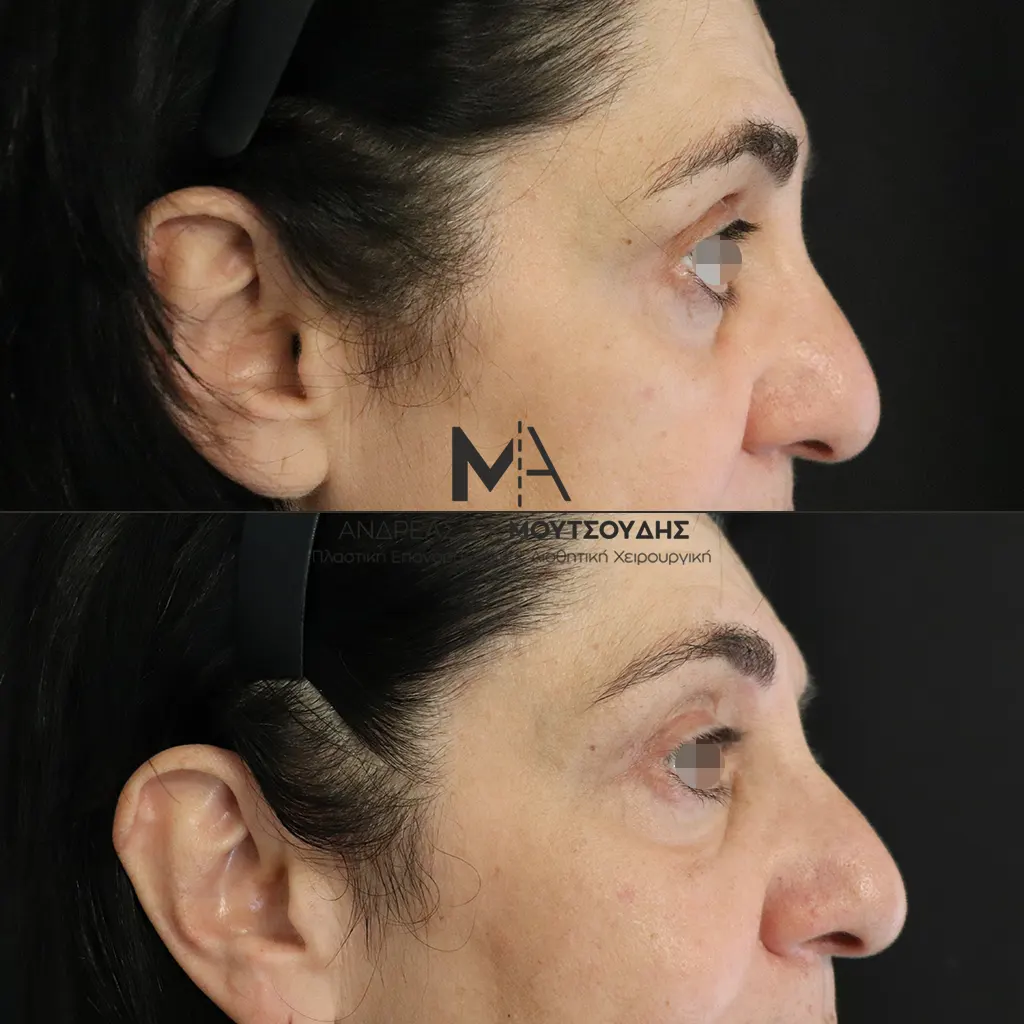 Βλεφαροπλαστική μέσα από αληθινές φωτογραφίες Πριν και Μετά