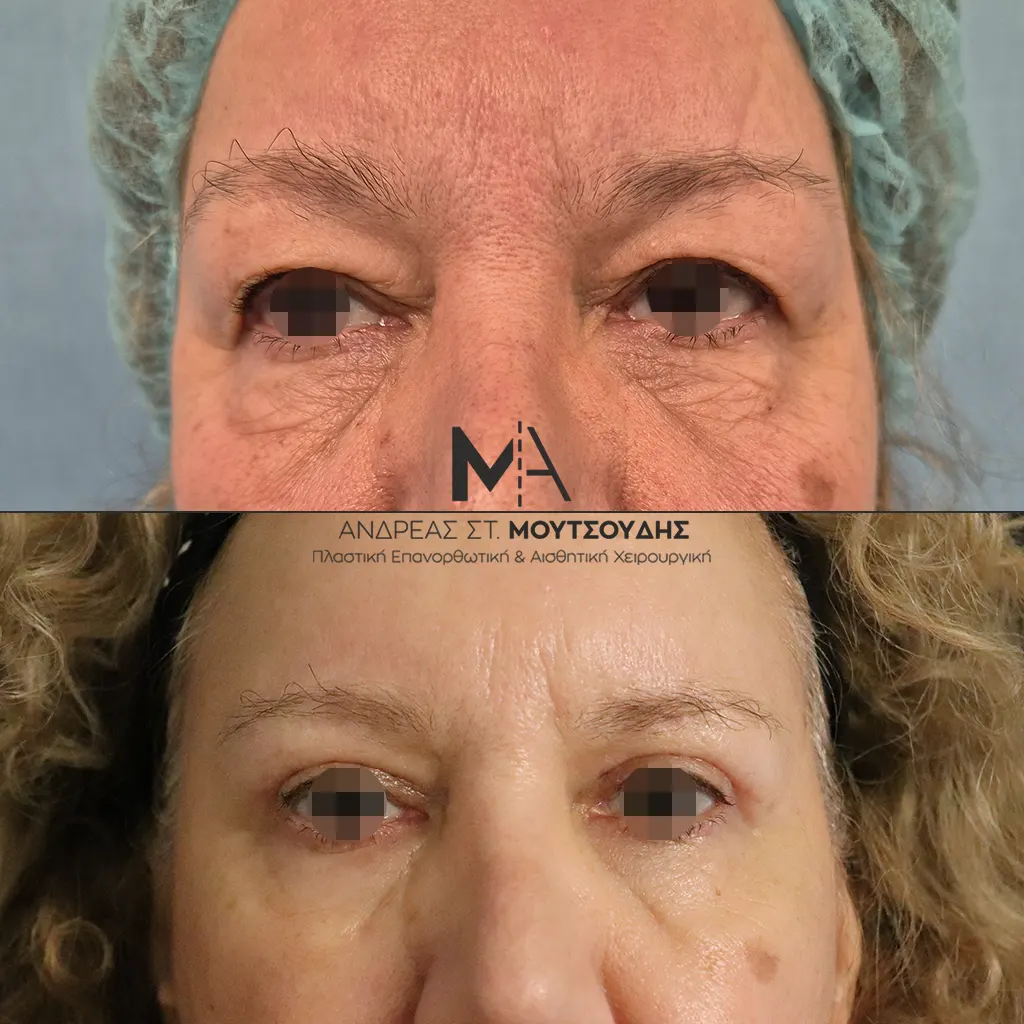 Βλεφαροπλαστική μέσα από αληθινές φωτογραφίες Πριν και Μετά
