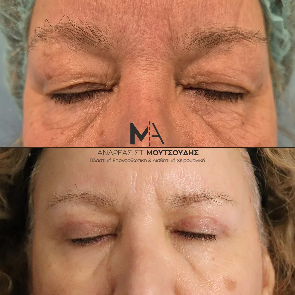 Βλεφαροπλαστική μέσα από αληθινές φωτογραφίες Πριν και Μετά