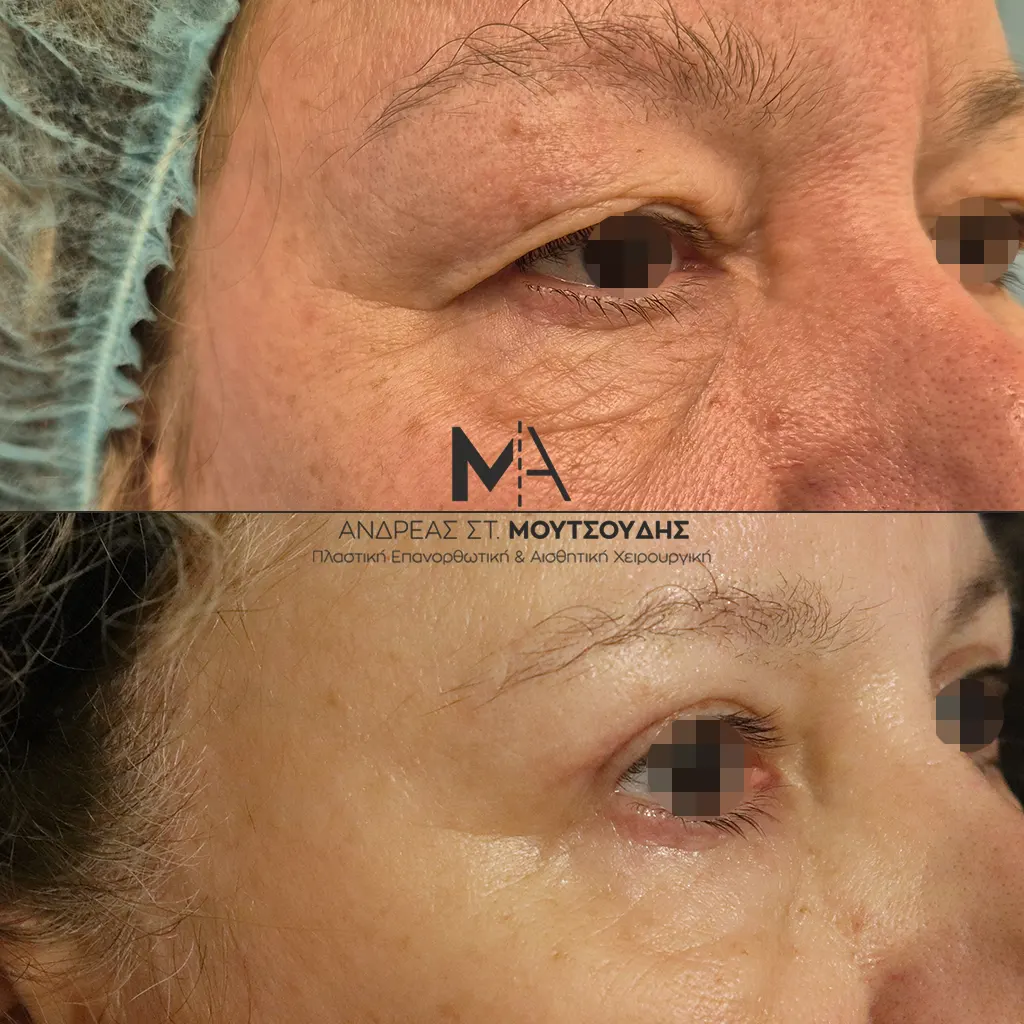 Βλεφαροπλαστική μέσα από αληθινές φωτογραφίες Πριν και Μετά