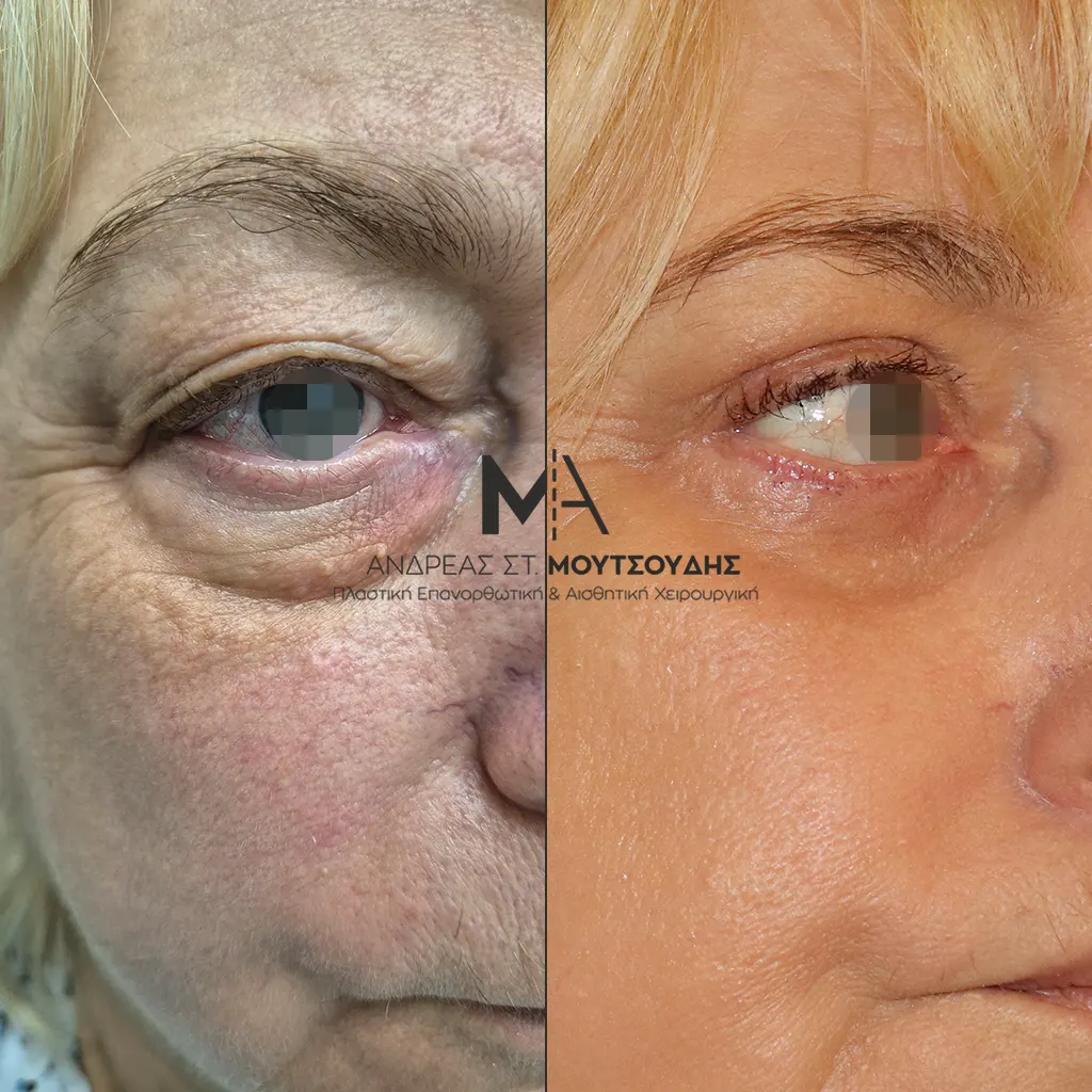 Βλεφαροπλαστική μέσα από αληθινές φωτογραφίες Πριν και Μετά