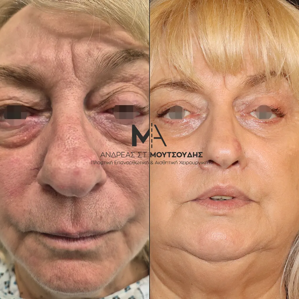 Βλεφαροπλαστική μέσα από αληθινές φωτογραφίες Πριν και Μετά