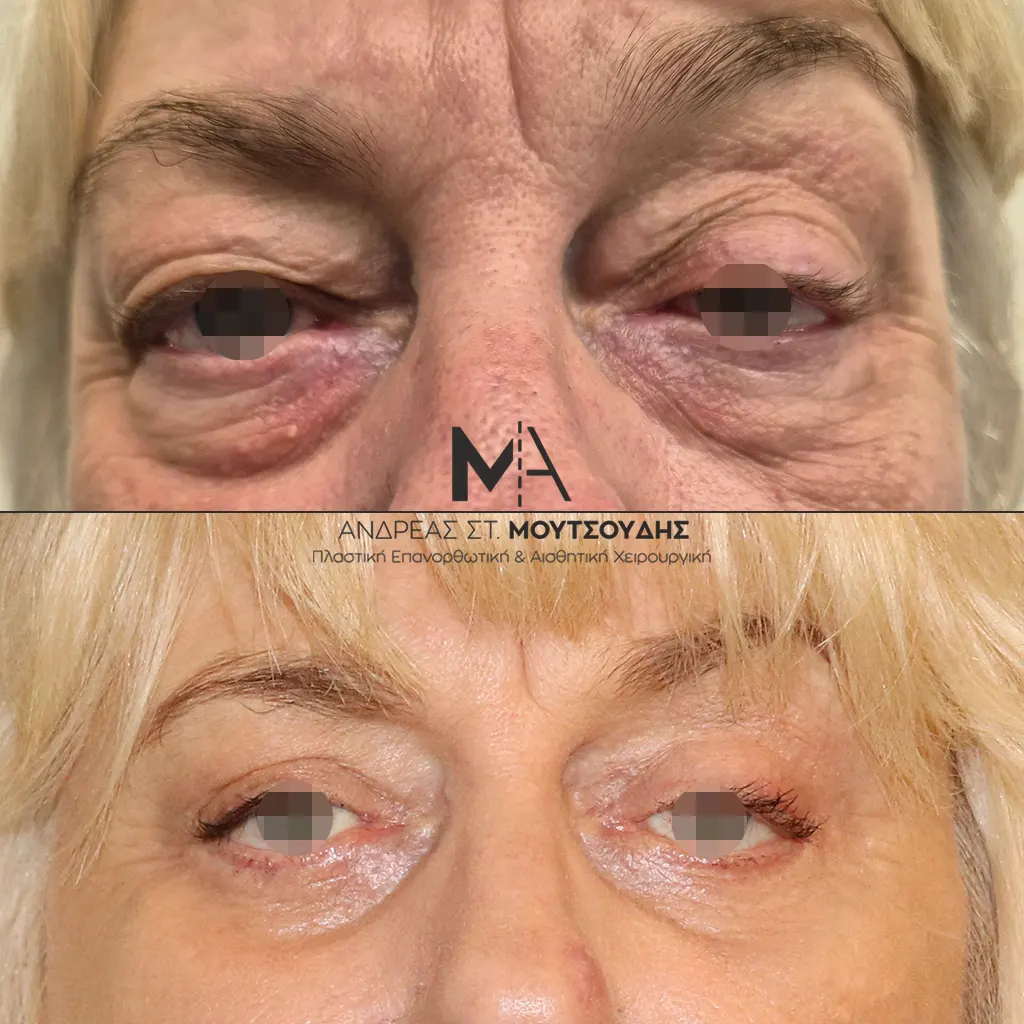 Βλεφαροπλαστική μέσα από αληθινές φωτογραφίες Πριν και Μετά