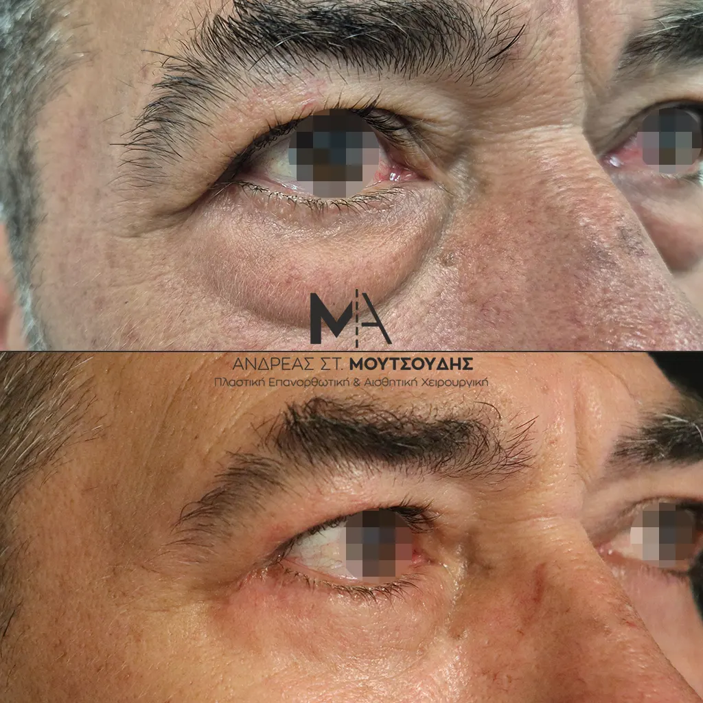 Κάτω βλεφαροπλαστική αληθινές φωτογραφίες Πριν και Μετά