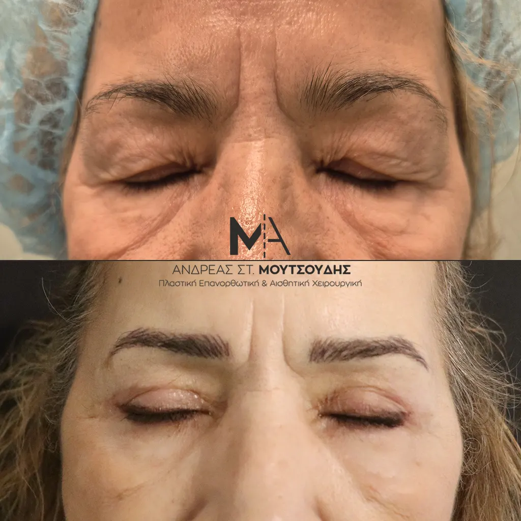 Κάτω βλεφαροπλαστική αληθινές φωτογραφίες Πριν και Μετά