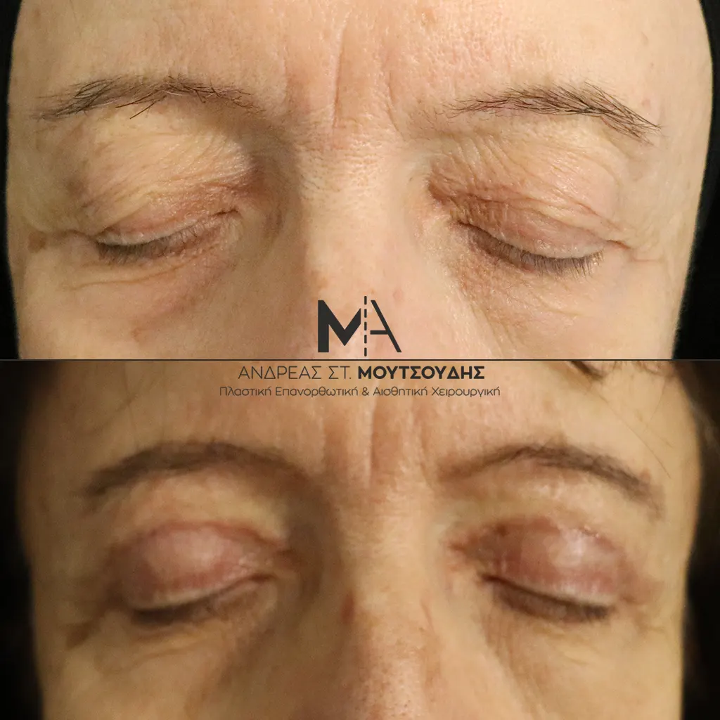 Βλεφαροπλαστική μέσα από αληθινές φωτογραφίες Πριν και Μετά