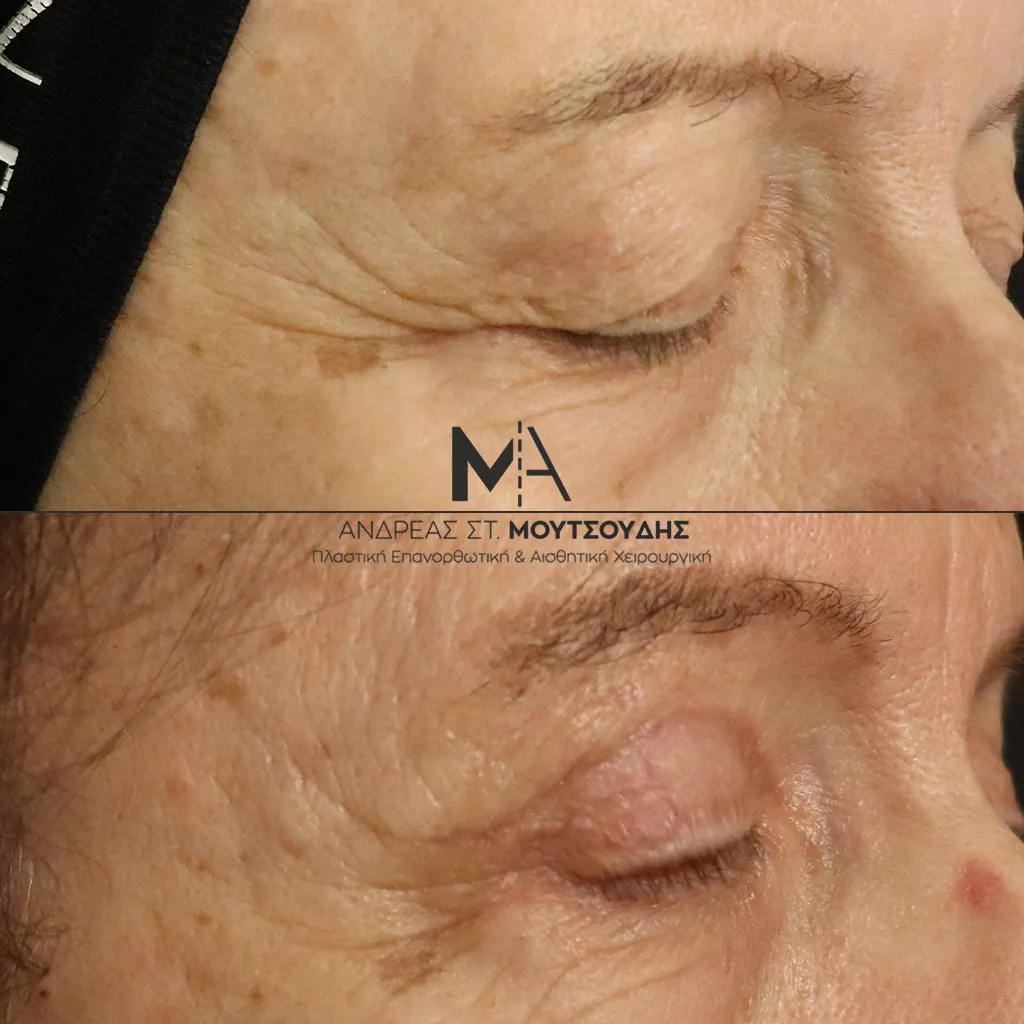 Βλεφαροπλαστική μέσα από αληθινές φωτογραφίες Πριν και Μετά