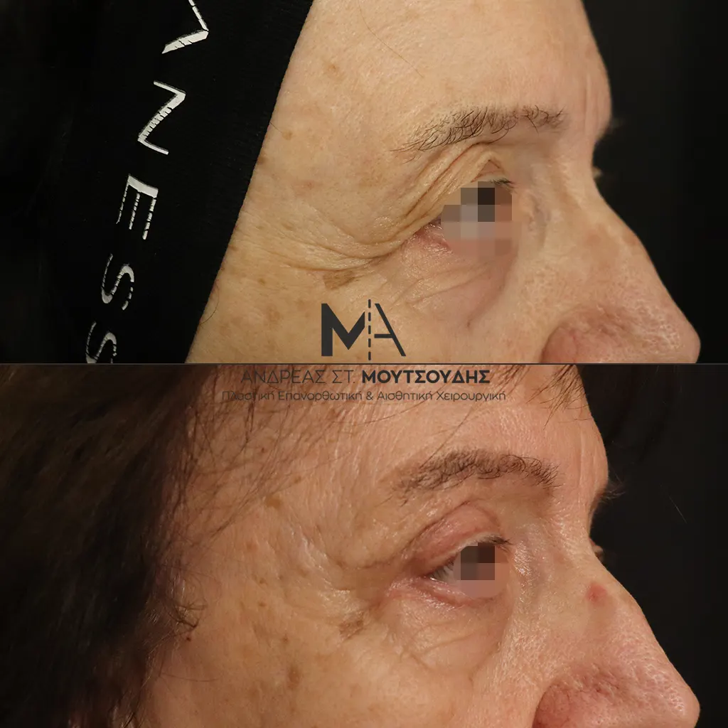 Βλεφαροπλαστική μέσα από αληθινές φωτογραφίες Πριν και Μετά