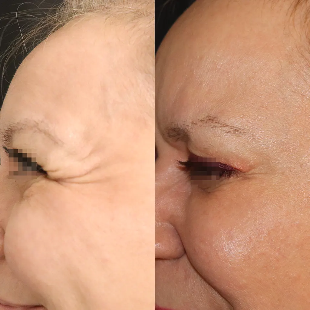 Botox - Μπότοξ μέσα από αληθινές εικόνες Πριν και Μετά