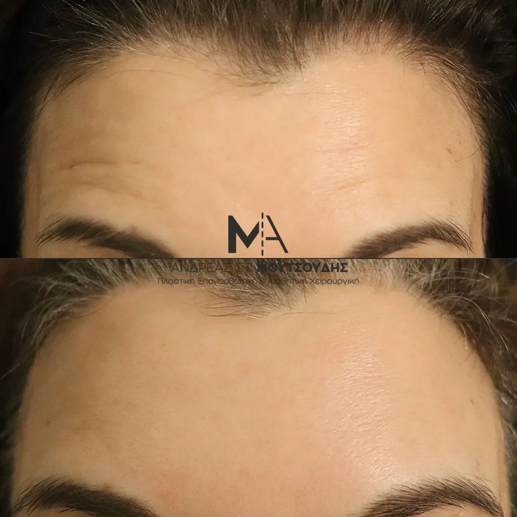 Botox - Μπότοξ μέσα από αληθινές εικόνες Πριν και Μετά