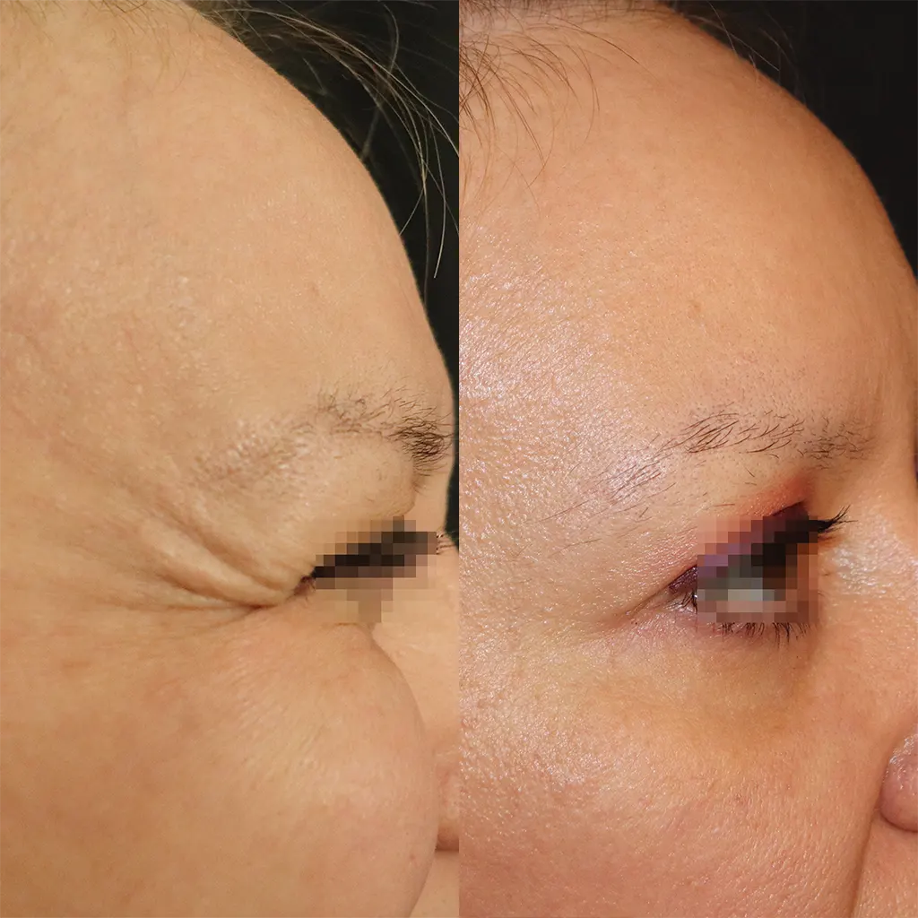 Botox - Μπότοξ μέσα από αληθινές εικόνες Πριν και Μετά