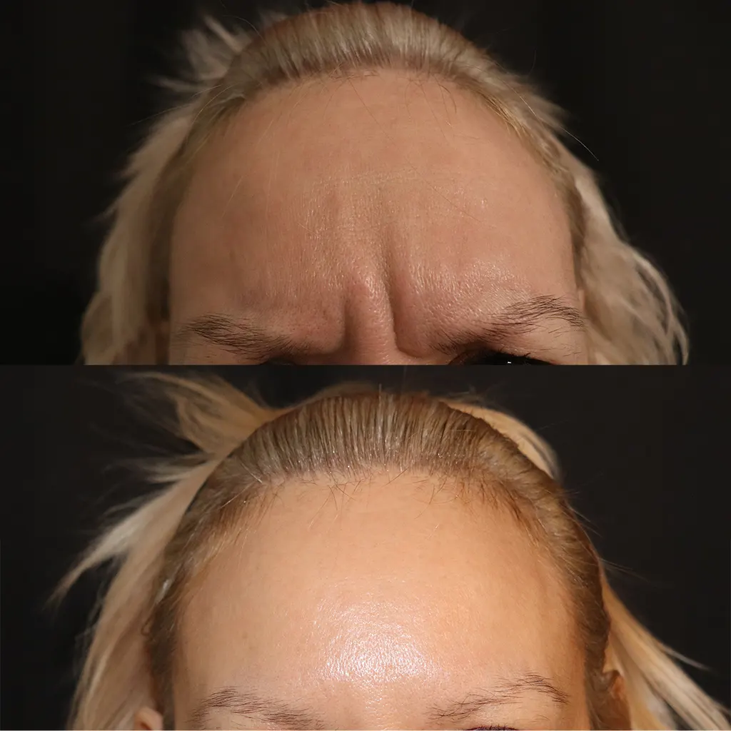 Botox - Μπότοξ μέσα από αληθινές εικόνες Πριν και Μετά