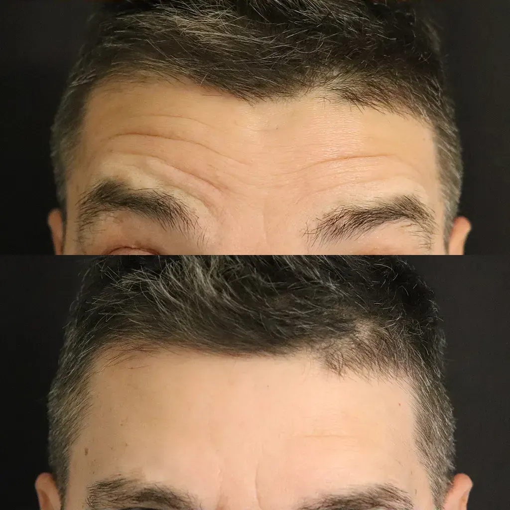 Botox - Μπότοξ μέσα από αληθινές εικόνες Πριν και Μετά