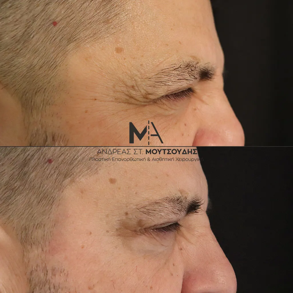 Botox - Μπότοξ μέσα από αληθινές εικόνες Πριν και Μετά