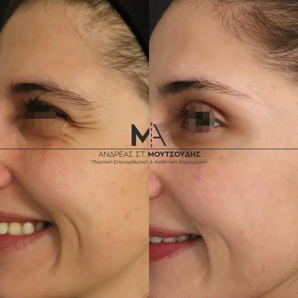 Botox - Μπότοξ μέσα από αληθινές εικόνες Πριν και Μετά