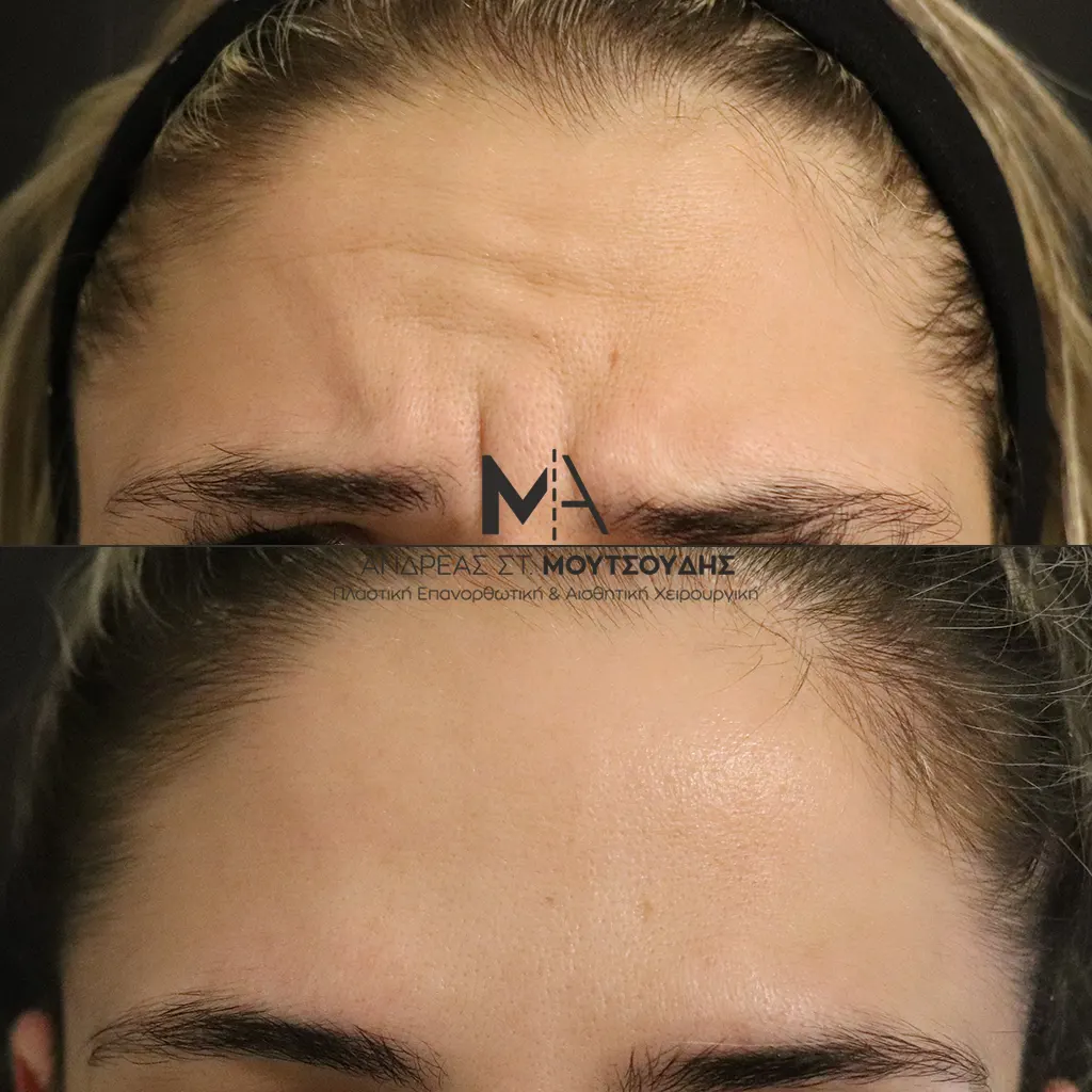 Botox - Μπότοξ μέσα από αληθινές εικόνες Πριν και Μετά