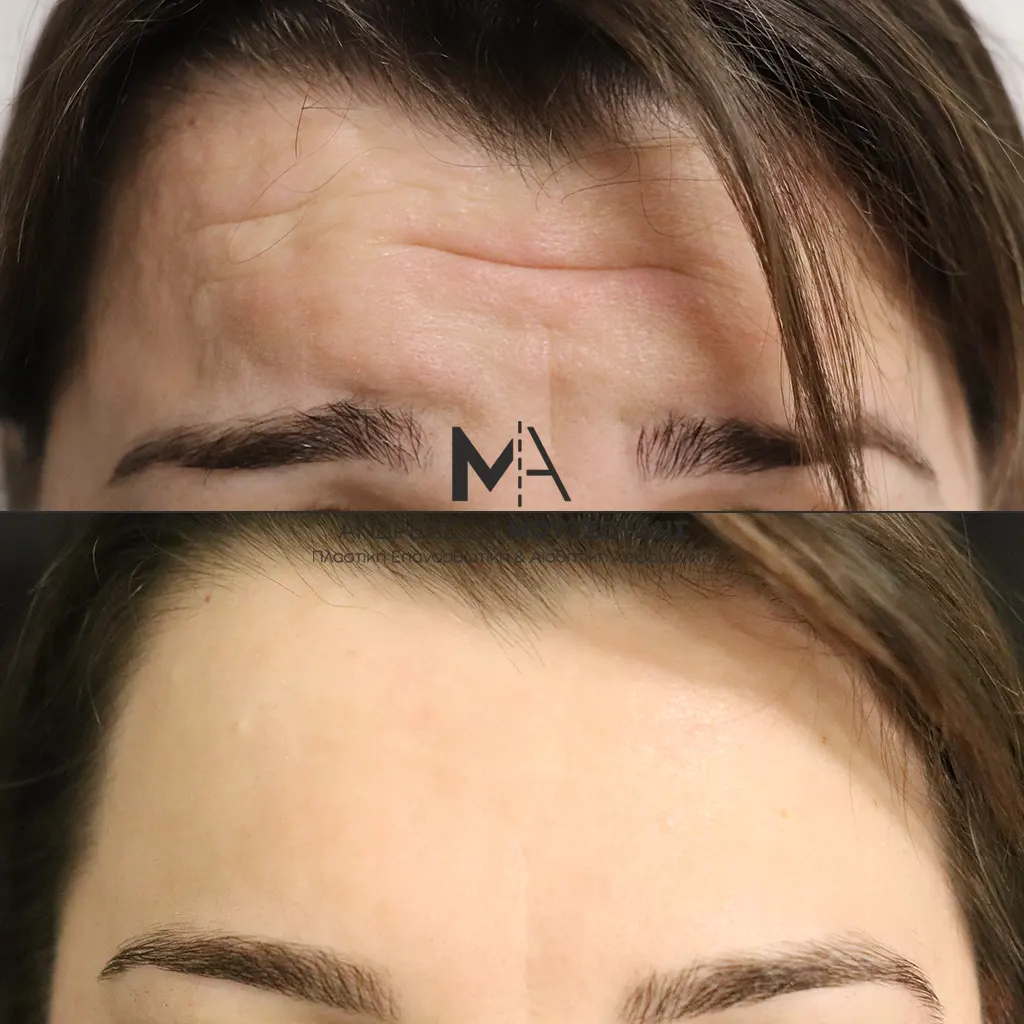 Botox - Μπότοξ μέσα από αληθινές εικόνες Πριν και Μετά
