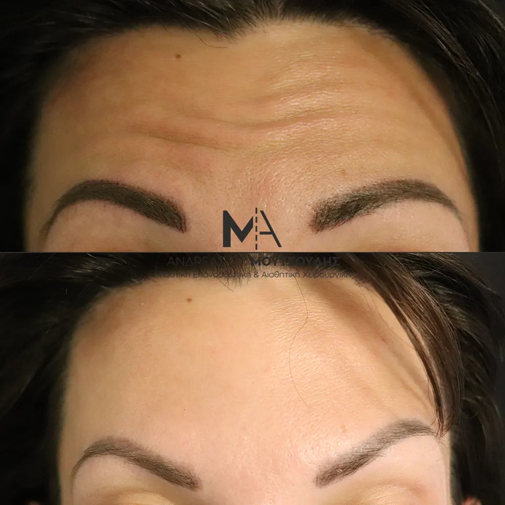 Botox - Μπότοξ μέσα από αληθινές εικόνες Πριν και Μετά