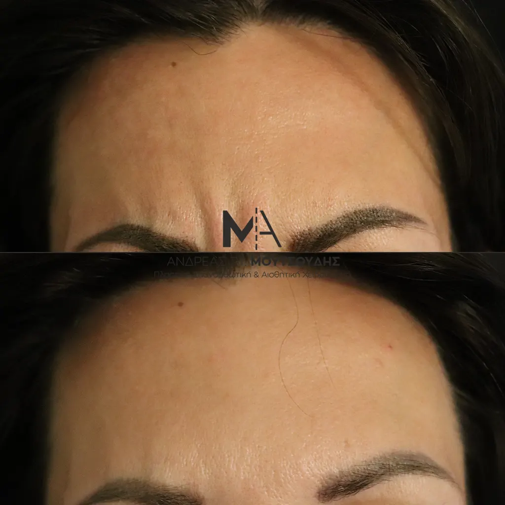 Botox - Μπότοξ μέσα από αληθινές εικόνες Πριν και Μετά