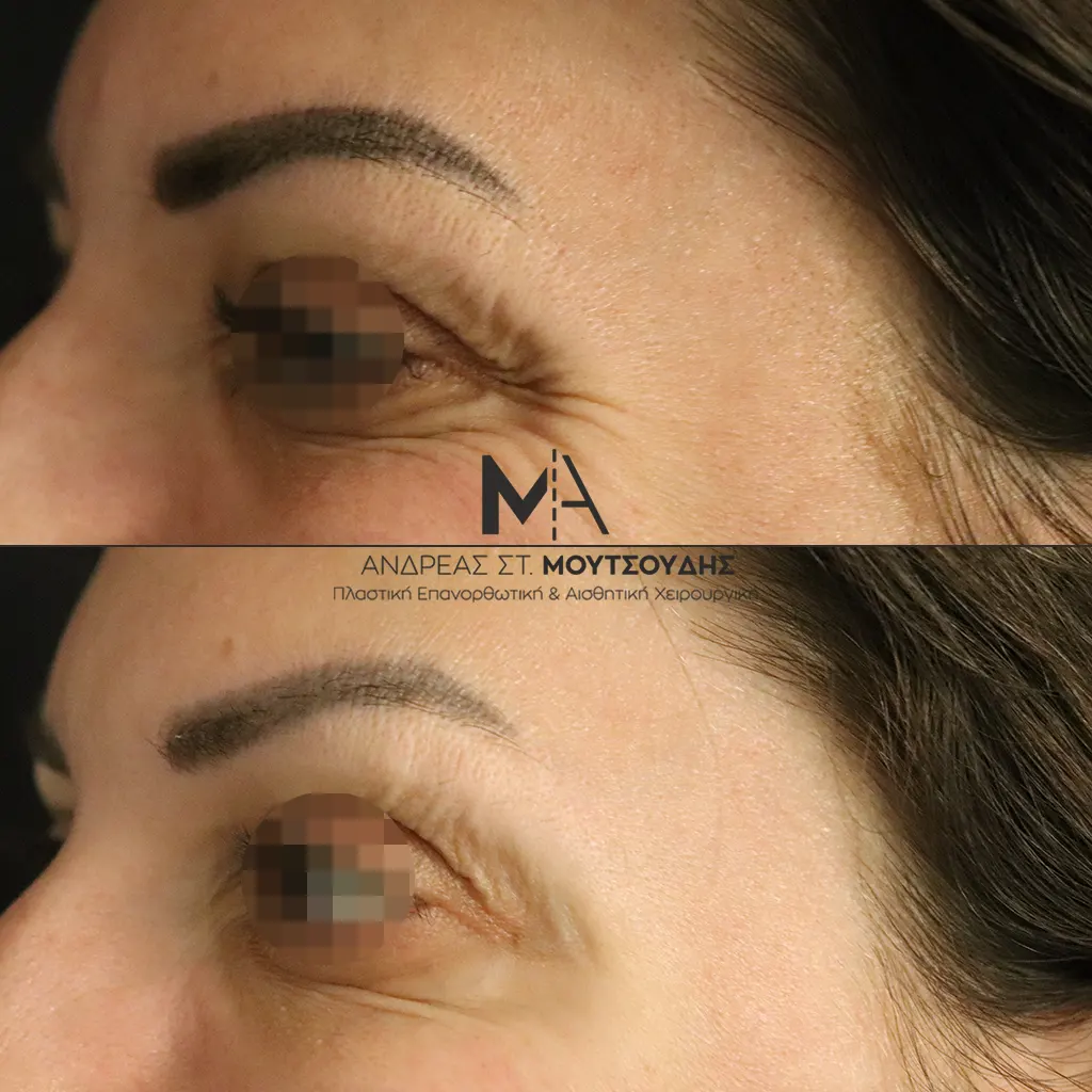 Botox - Μπότοξ μέσα από αληθινές εικόνες Πριν και Μετά