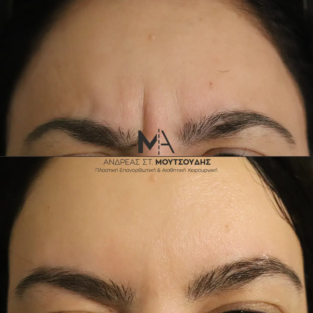 Botox - Μπότοξ μέσα από αληθινές εικόνες Πριν και Μετά