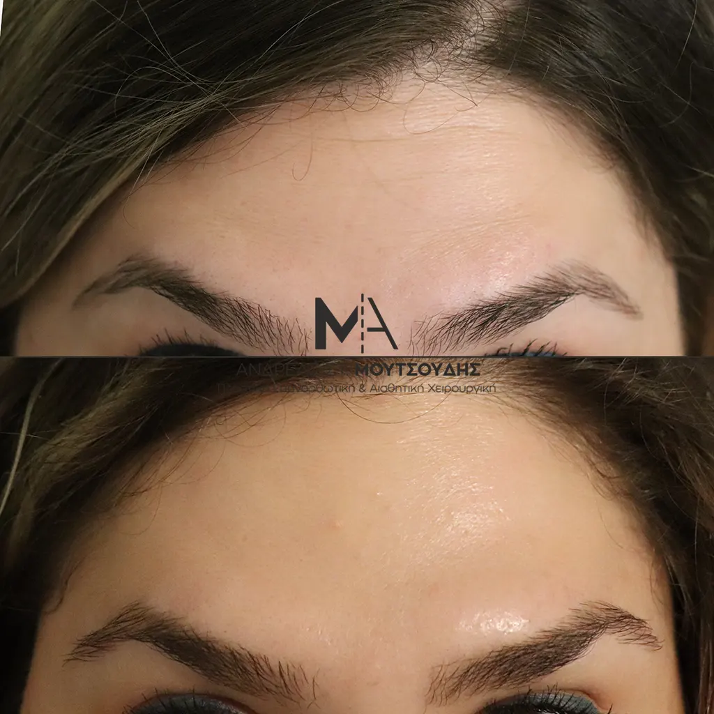Botox - Μπότοξ μέσα από αληθινές εικόνες Πριν και Μετά