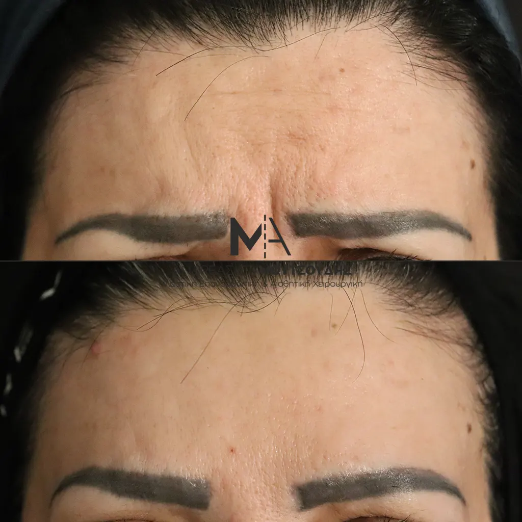 Botox - Μπότοξ μέσα από αληθινές εικόνες Πριν και Μετά