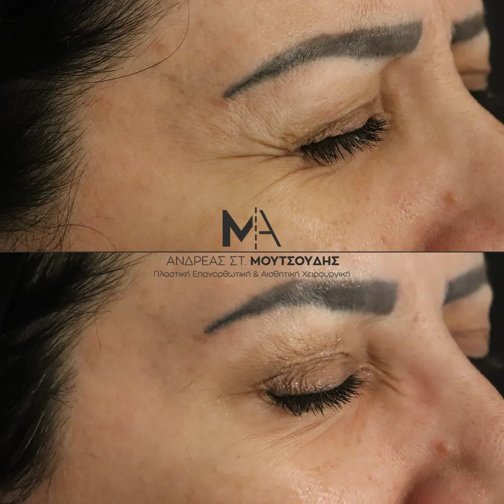 Botox - Μπότοξ μέσα από αληθινές εικόνες Πριν και Μετά