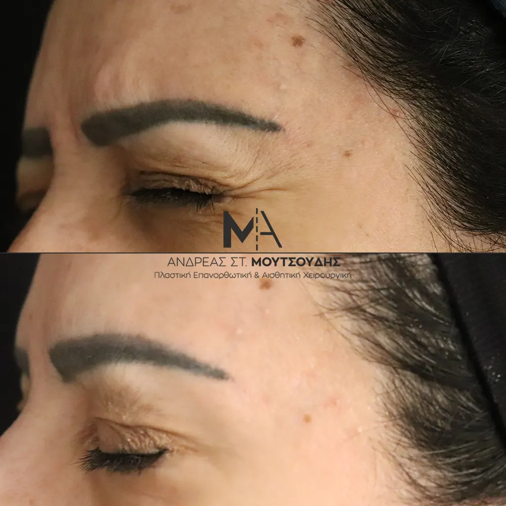 Botox - Μπότοξ μέσα από αληθινές εικόνες Πριν και Μετά