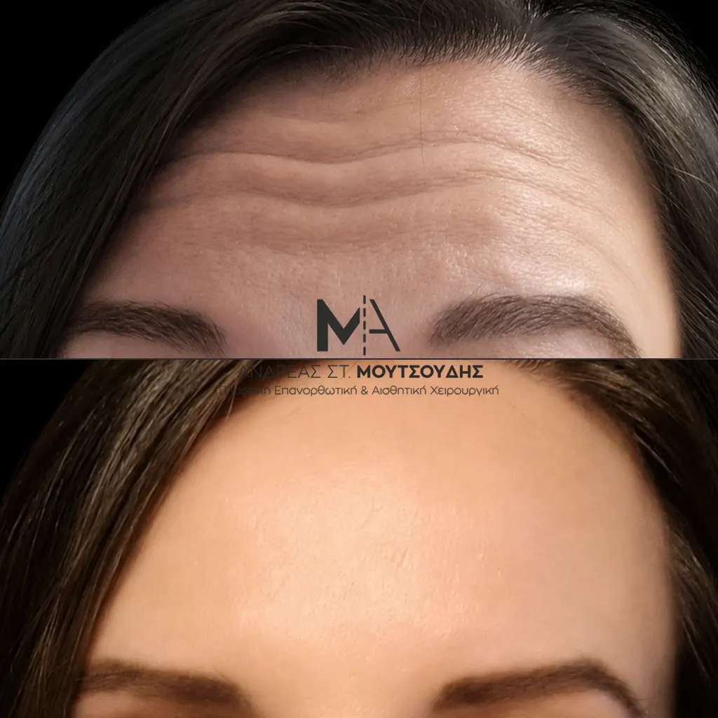 Botox - Μπότοξ μέσα από αληθινές εικόνες Πριν και Μετά