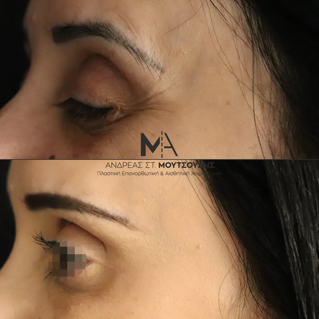Botox - Μπότοξ μέσα από αληθινές εικόνες Πριν και Μετά