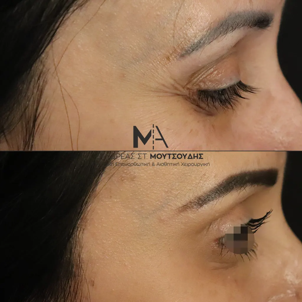 Botox - Μπότοξ μέσα από αληθινές εικόνες Πριν και Μετά