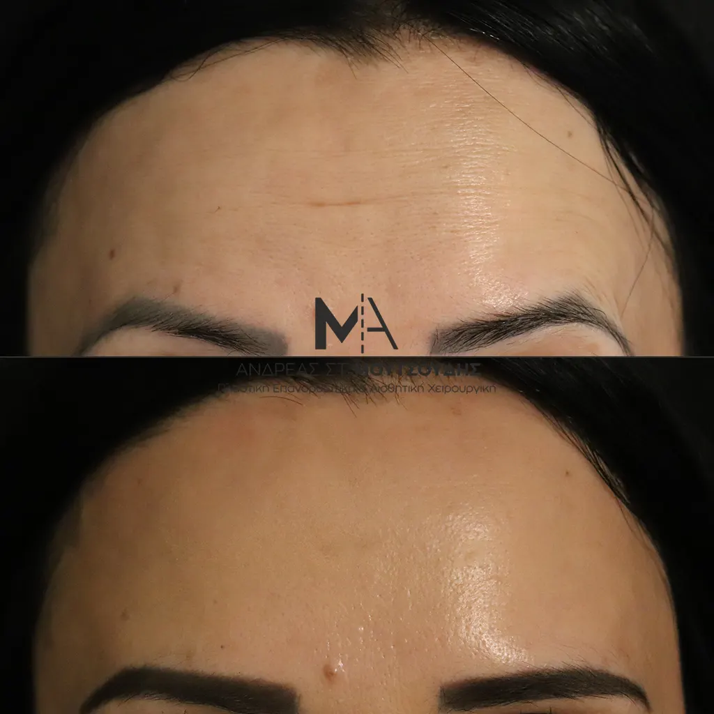 Botox - Μπότοξ μέσα από αληθινές εικόνες Πριν και Μετά