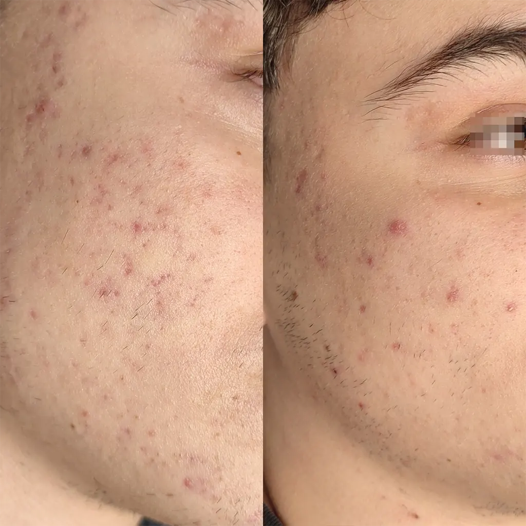 Εφαρμογή του Gentlo αληθινές φωτογραφίες Πριν και Μετά