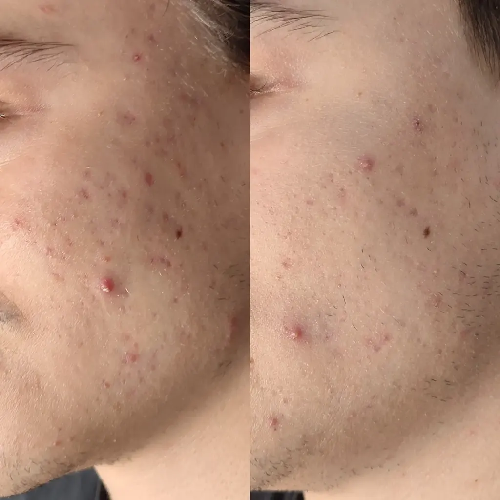 Εφαρμογή του Gentlo αληθινές φωτογραφίες Πριν και Μετά