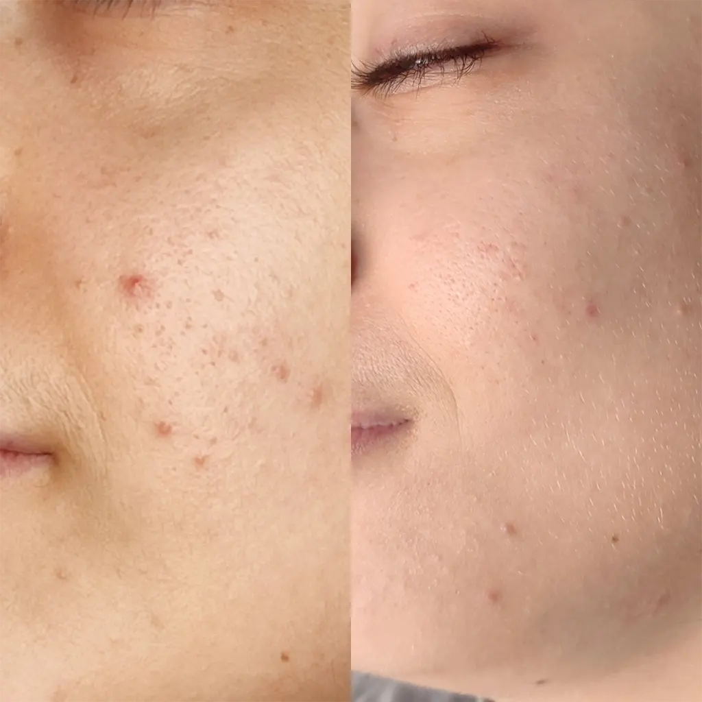 Εφαρμογή του Gentlo αληθινές φωτογραφίες Πριν και Μετά