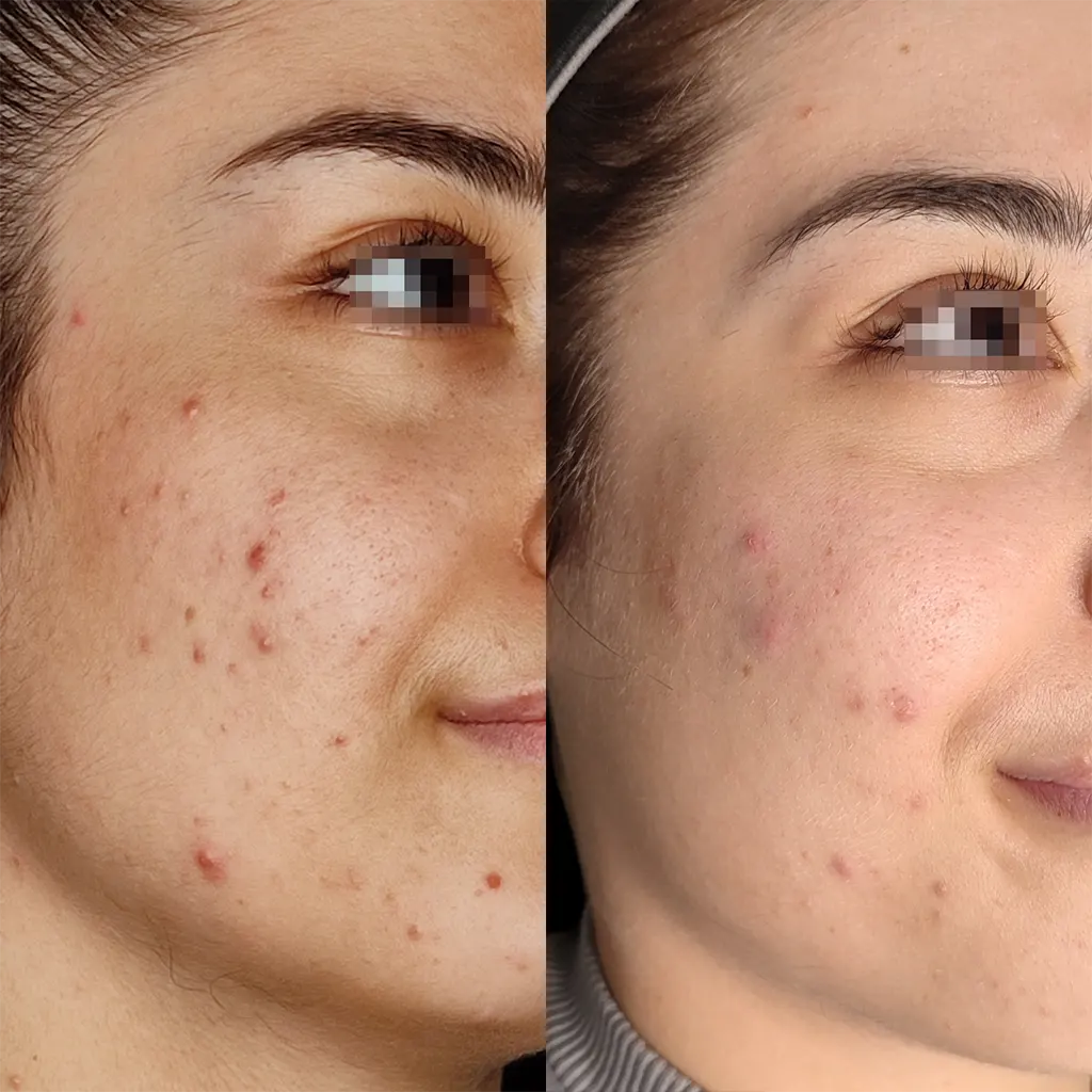 Εφαρμογή του Gentlo αληθινές φωτογραφίες Πριν και Μετά