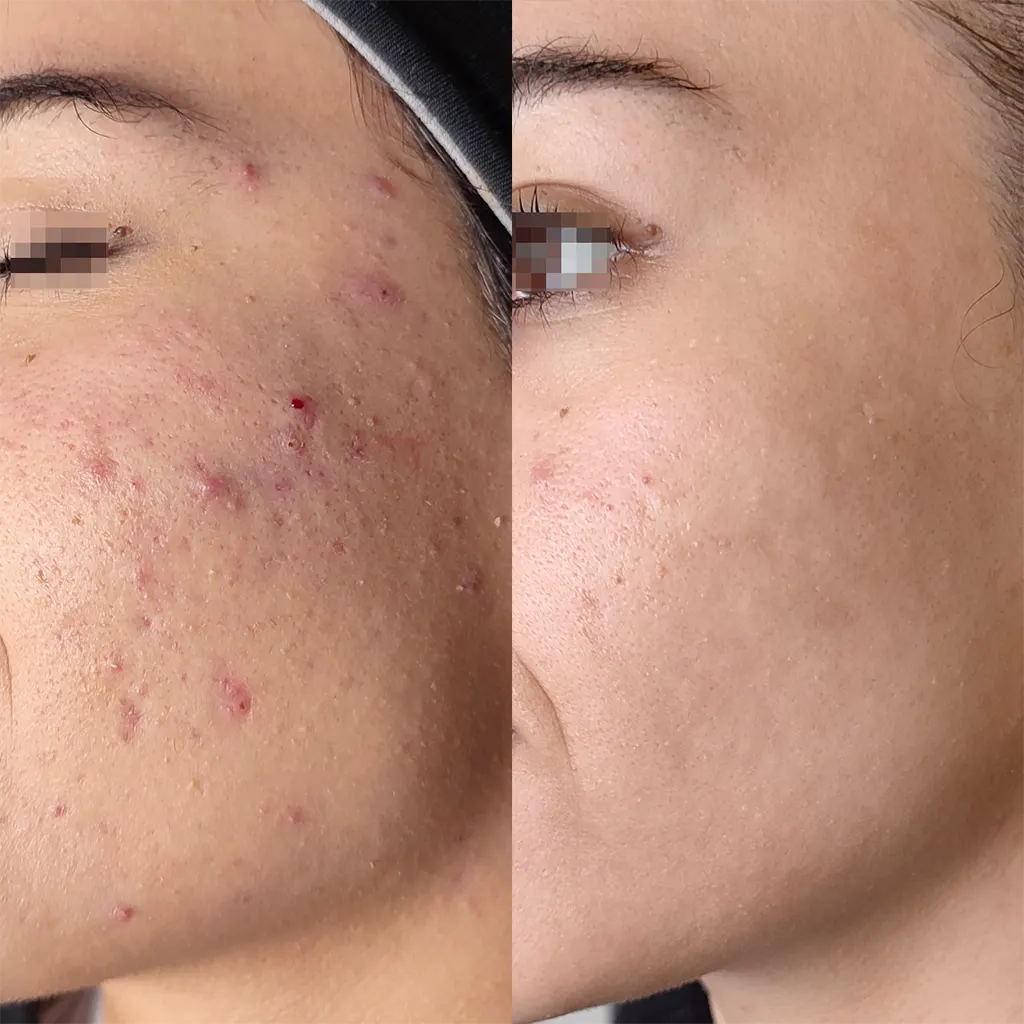 Εφαρμογή του Gentlo αληθινές φωτογραφίες Πριν και Μετά