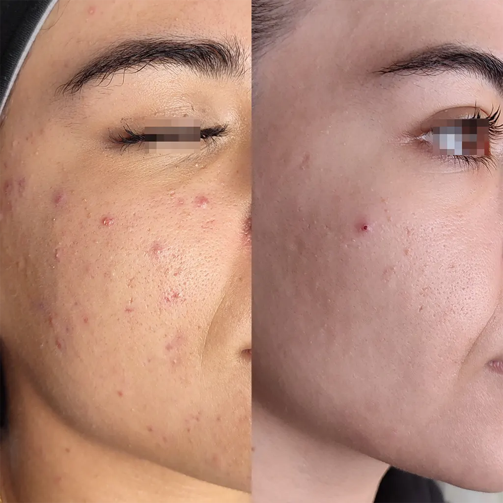 Εφαρμογή του Gentlo αληθινές φωτογραφίες Πριν και Μετά