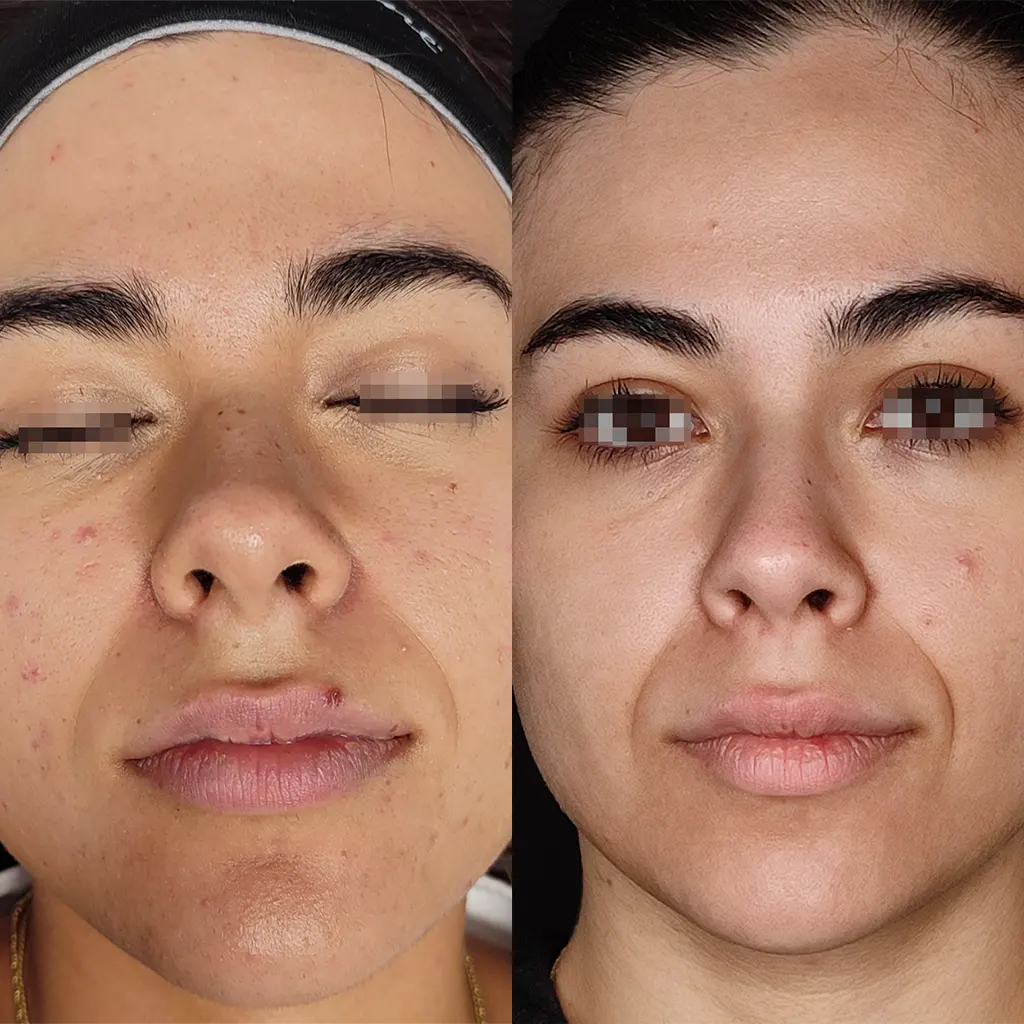 Εφαρμογή του Gentlo αληθινές φωτογραφίες Πριν και Μετά