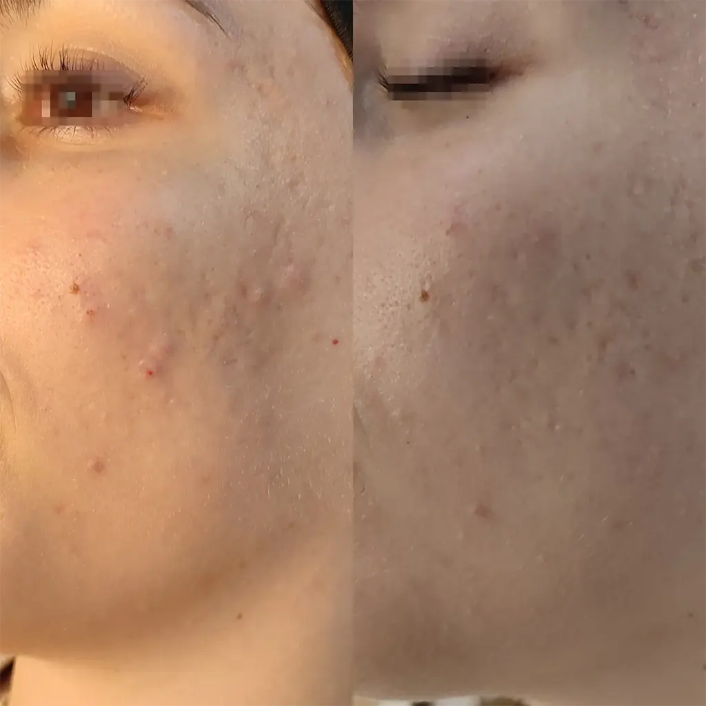 Εφαρμογή του Gentlo αληθινές φωτογραφίες Πριν και Μετά