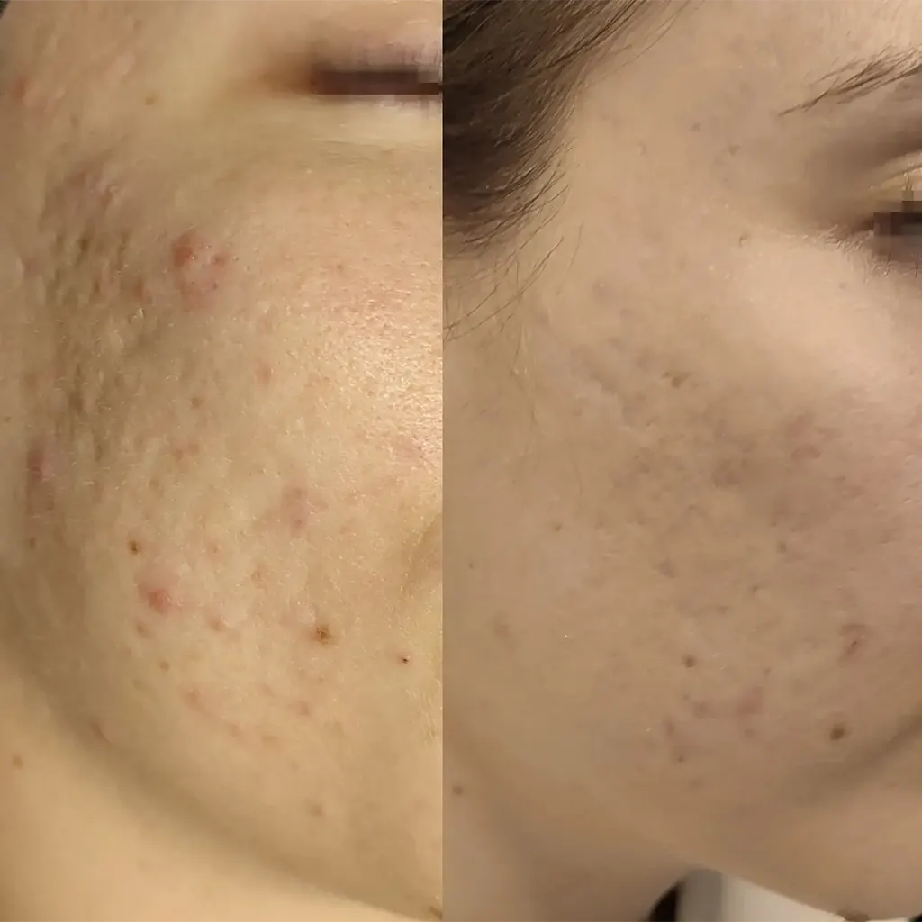 Εφαρμογή του Gentlo αληθινές φωτογραφίες Πριν και Μετά