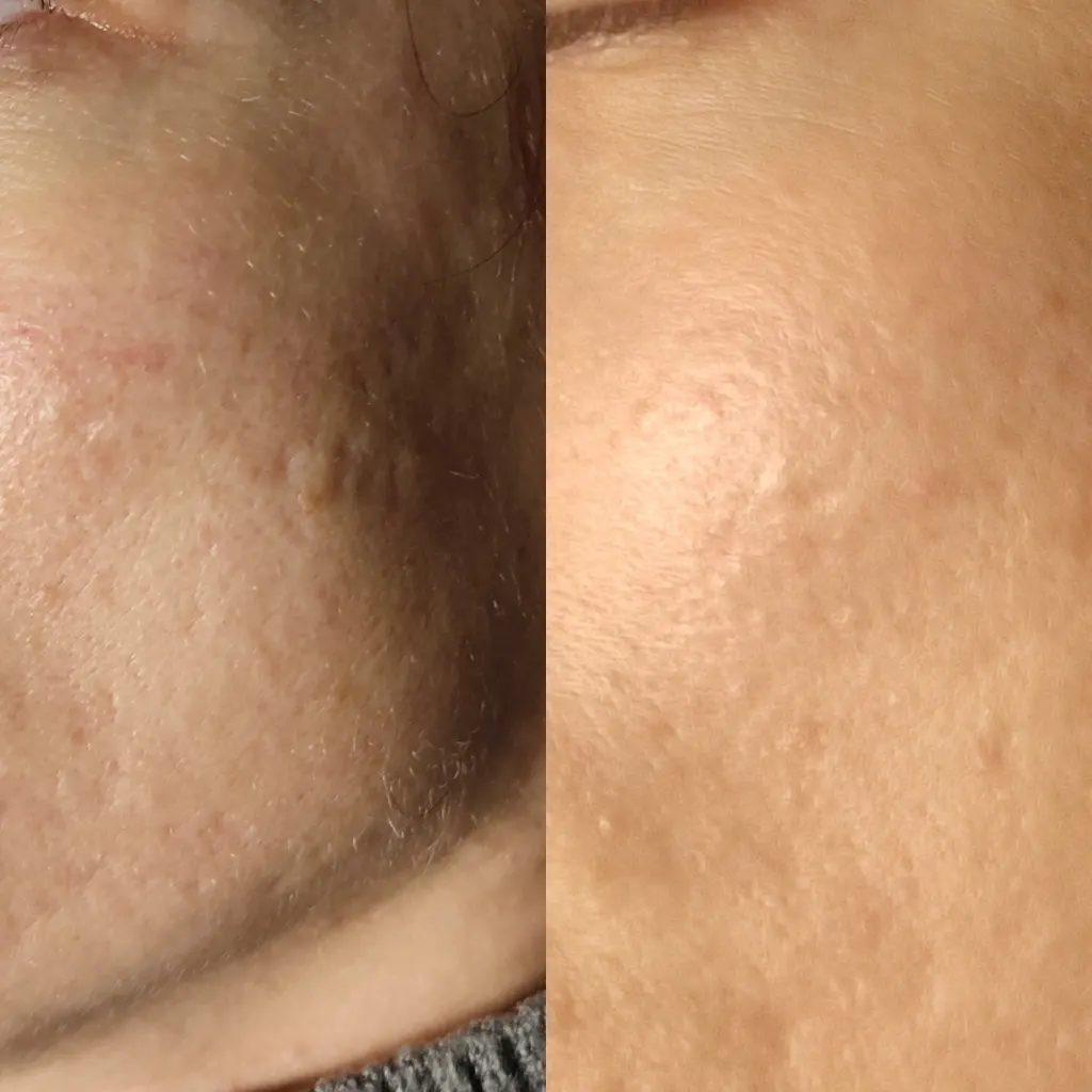 Εφαρμογή του Gentlo αληθινές φωτογραφίες Πριν και Μετά