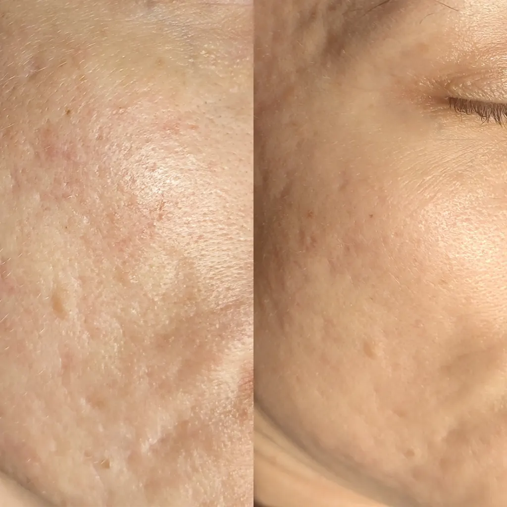 Εφαρμογή του Gentlo αληθινές φωτογραφίες Πριν και Μετά