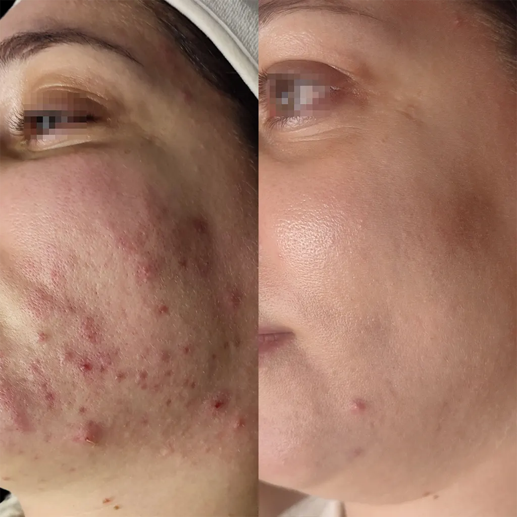 Εφαρμογή του Gentlo αληθινές φωτογραφίες Πριν και Μετά