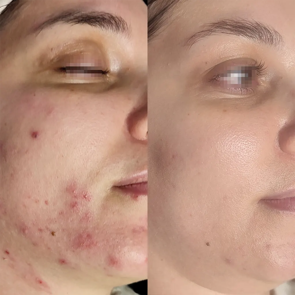 Εφαρμογή του Gentlo αληθινές φωτογραφίες Πριν και Μετά