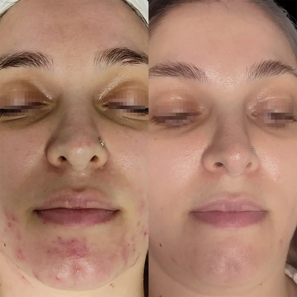 Εφαρμογή του Gentlo αληθινές φωτογραφίες Πριν και Μετά