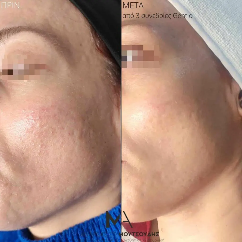 Εφαρμογή του Gentlo αληθινές φωτογραφίες Πριν και Μετά